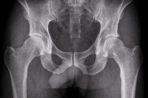 options to diagnose osteoarthritis of the hip joint