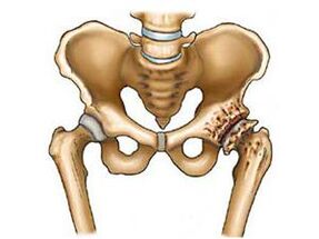 what is arthrosis of the hip joint
