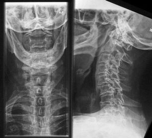 X-ray of the cervical spine - a method to diagnose osteochondrosis