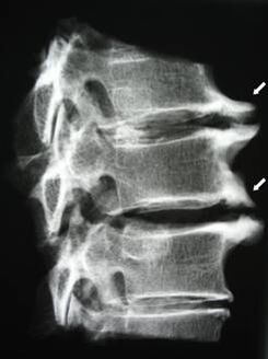 Osteophytes of the cervical spine cause pain in the neck