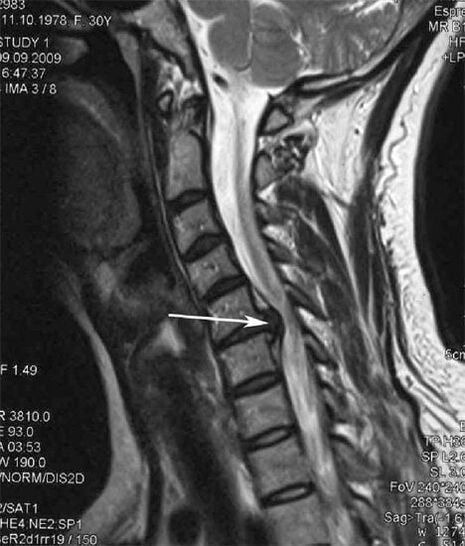Spinal cord injury triggers neck pain
