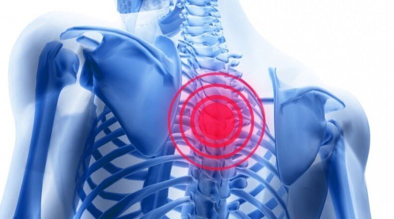 back pain may be associated with a herniated disc