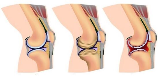 a healthy joint and pain in knee joint destruction