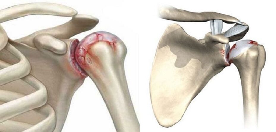 destruction of the shoulder joint with osteoarthritis