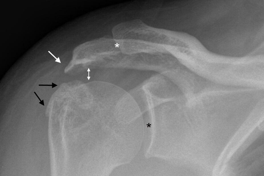 osteoarthritis of the shoulder joint on x-ray