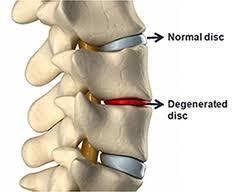 normal ROM of the spine, the damaged disc